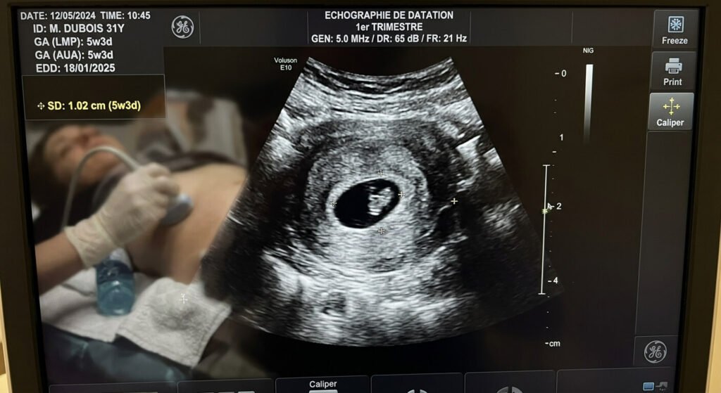 Activité cardiaque de l'embryon tardive : quand s'inquiéter et quelle conduite adopter ? 3 Écran d'échographie de datation montrant un sac gestationnel au tout début du premier trimestre.