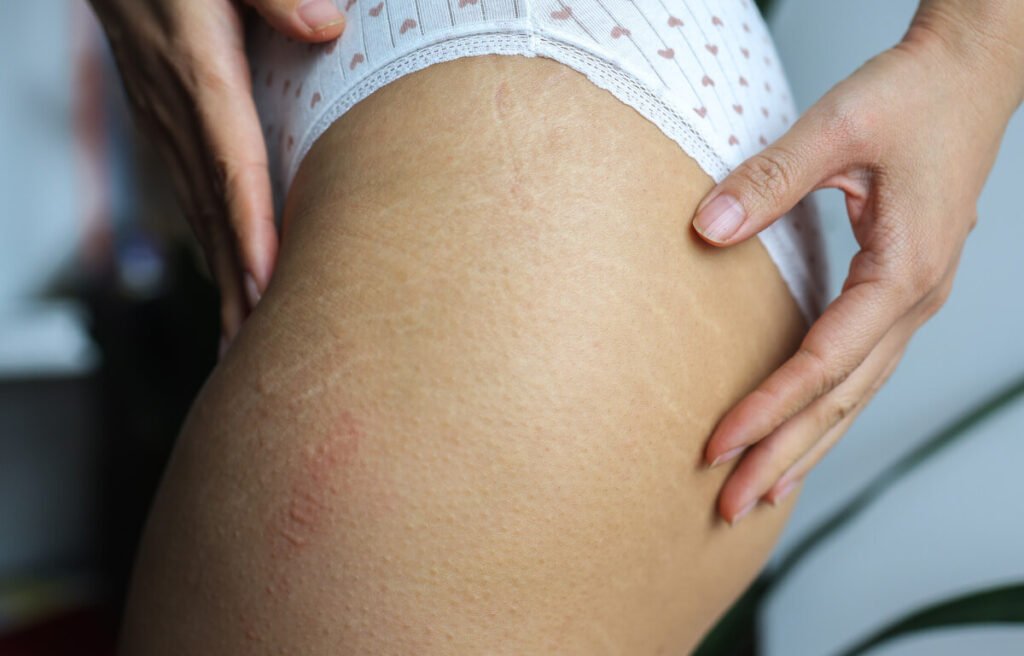 Comment traiter un bouton sur une vergeture ? 3 Zoom sur une zone de vergetures présentant une petite inflammation cutanée ou un bouton rouge.