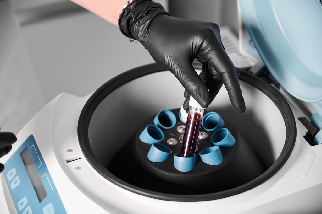 Tubes de sang après centrifugation séparant le plasma riche en plaquettes des globules rouges.