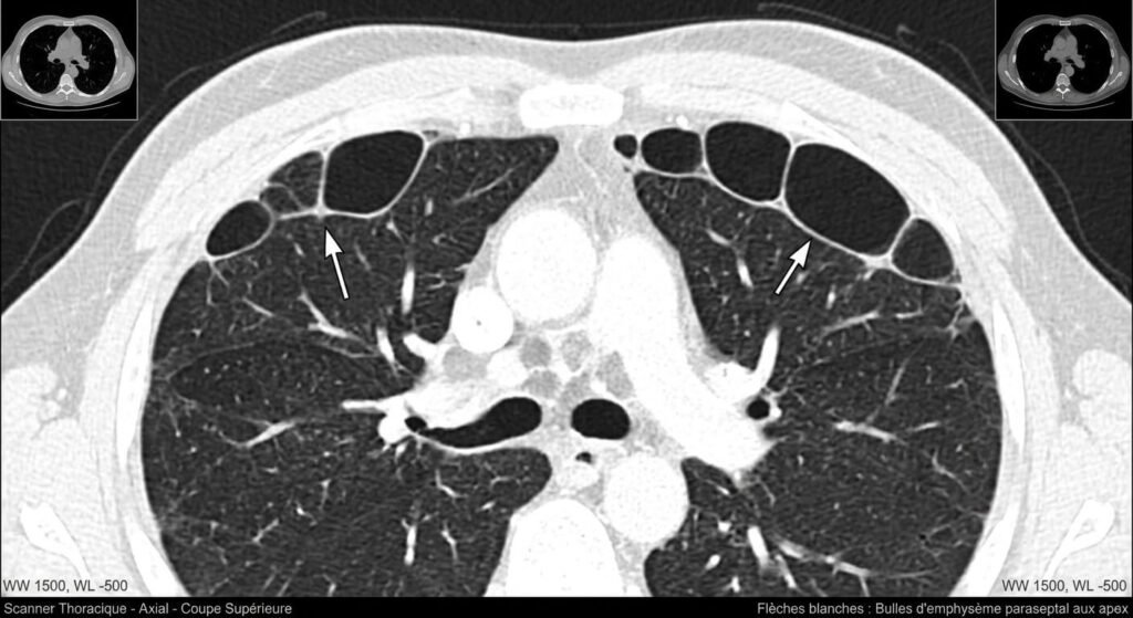 Emphysème paraseptal des apex : définition, scanner et risques 2 Coupe de scanner thoracique montrant des bulles d'emphysème paraseptal aux apex pulmonaires.