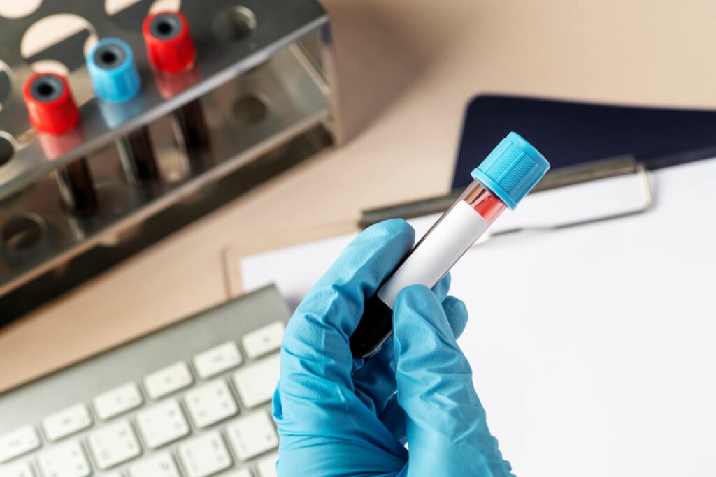 Taux de créatinine élevée : causes et quand s'inquiéter 2 Tube d'analyse sanguine au laboratoire médical pour le dosage de la créatinine sérique.