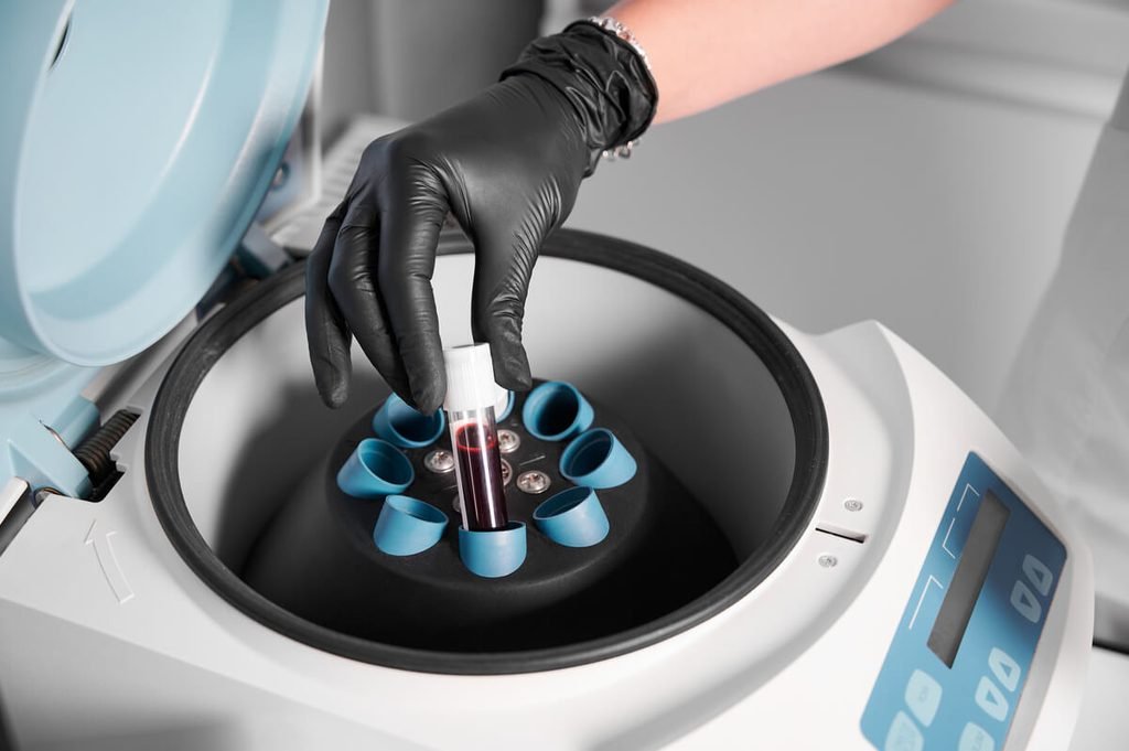 Préparation et centrifugation d'un tube de sang pour isoler le plasma riche en plaquettes avant injection capillaire.