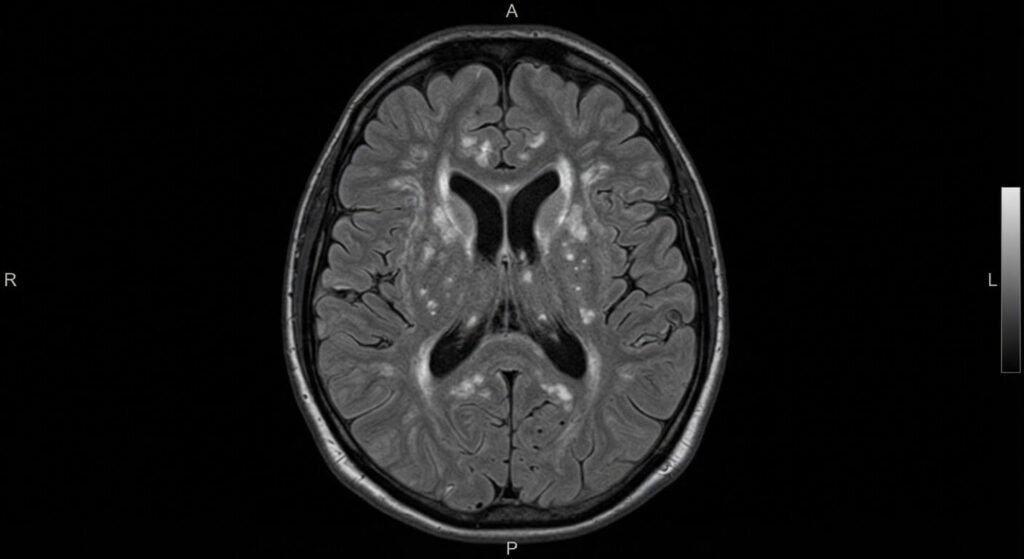 Leucopathie vasculaire grade 2 de Fazekas et Schmidt : signification et prise en charge 2 Coupe axiale d'IRM cérébrale en séquence FLAIR montrant des hypersignaux de la substance blanche de stade 2.