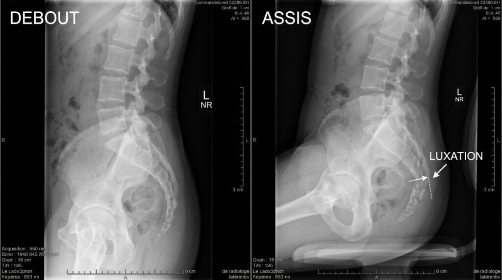 Ablation du coccyx (coccygectomie) : témoignages, suites et reprise assise 2 Cliché radiologique montrant une luxation du coccyx avec mobilité anormale en position assise.