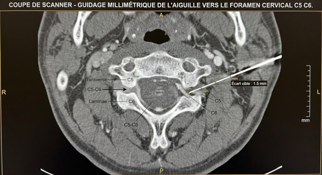 Coupe de scanner montrant le guidage millimétrique de l'aiguille vers le foramen cervical C5 C6.