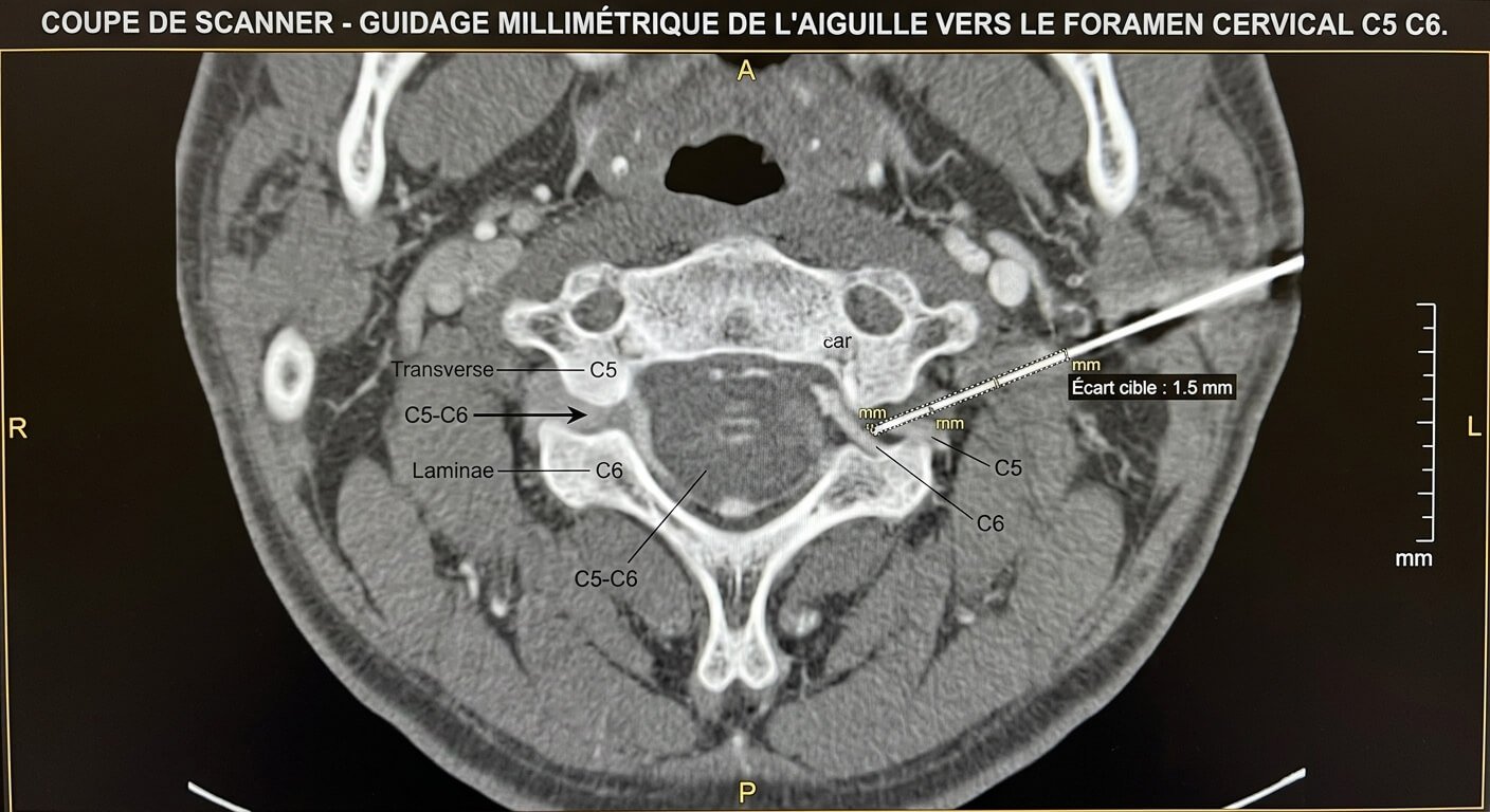Coupe de scanner montrant le guidage millimétrique de l'aiguille vers le foramen cervical C5 C6.